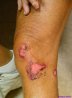Wound1.JPG