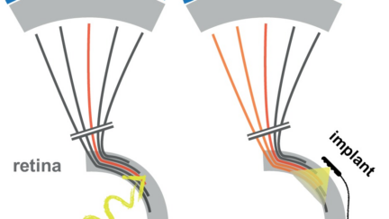 Improvement in the resolution of Retinal Prostheses