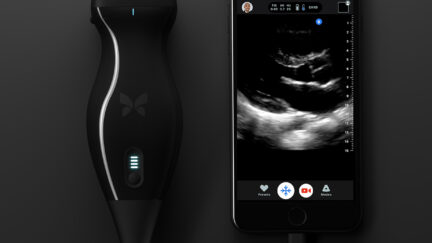 Butterfly IQ – Ultrasound Anywhere, Anytime